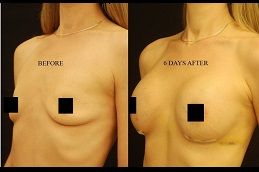 aft-breast-augmentation in Abu Dhabi