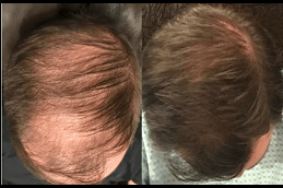 baldness-treatment-for-male in Abu Dhabi