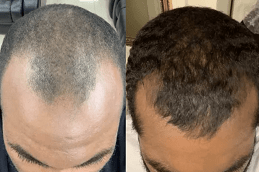baldness-treatment-for-male in dubai