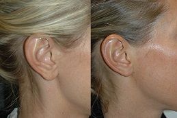 best earlobe-repair-reduction in dubai