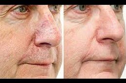 best facial-capillaries-treatment in dubai