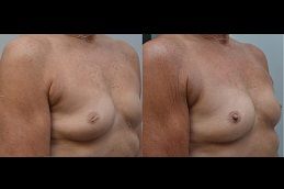 best inverted-nipple-surgery in dubai