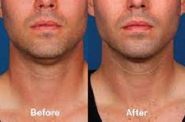 best kybella-treatment-for-double-chin in dubai