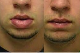 best lip-reduction in dubai