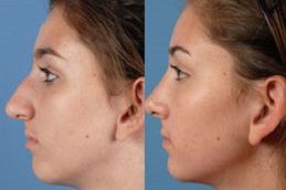 best rhinoplasty-nose-surgery in dubai
