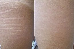 best stretch-marks-removal in dubai