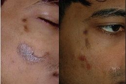 best surgical-scar-revision in dubai