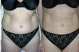 body-jet-liposuction in dubai