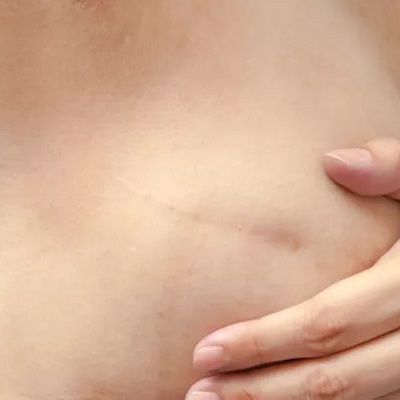 breast cyst surgery