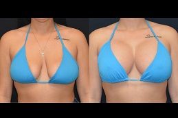 breast-implant in dubai