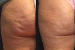 cellulite-removal-treatment in Abu Dhabi