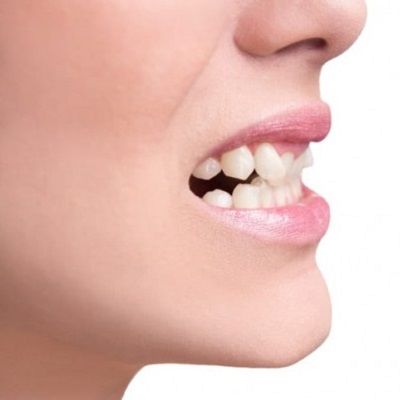 Do You Need Benefit From An Orthodontist to Fix Crooked Teeth?