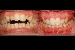 crooked-teeth-treatment in dubai