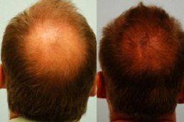crown-hair-transplant in dubai