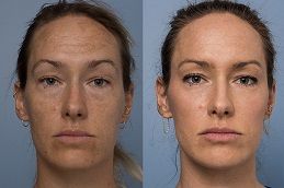 dermal-fillers-injections Clinic in Dubai