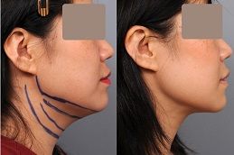 double-chin-liposuction Clinic in Dubai