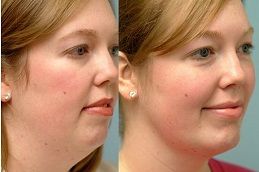double-chin-removal in dubai
