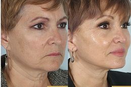 facial-reconstruction-surgery in dubai