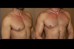 gynecomastia-male-breast-reduction in Abu Dhabi