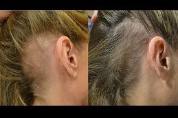 hair-fall-treatments Clinic in Dubai