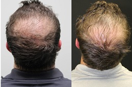 hair-fillers-for-baldness Clinic in Dubai