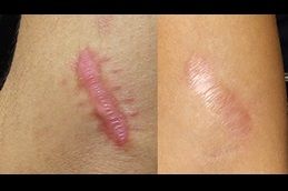 hypertrophic-scars-treatment Clinic in Dubai