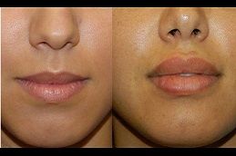 lip-reduction Clinic in Dubai