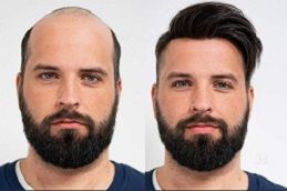 non-surgical-hair-replacement Clinic in Dubai