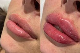 russian lip fillers Clinic in Dubai
