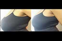 scarless-breast-augmentation