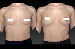 short-scar-breast-augmentation in dubai