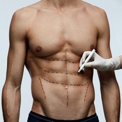 A Liposuction Procedure Promises 6-Pack Abs Without Lifting a Finger