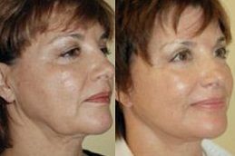 stemcell-facelift-treatment in dubai