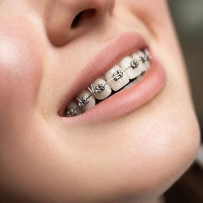 What Are The Pros And Cons Of Dental Braces?