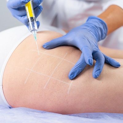 fat dissolving injections