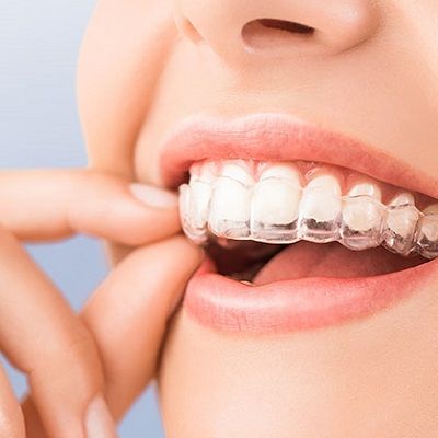 Aligners dubai