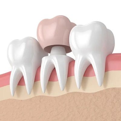 Dental Crowns and Bridges in Dubai | Cost