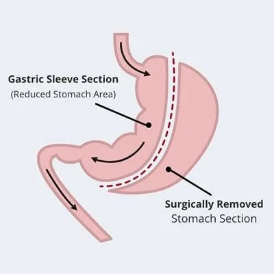 Gastric Sleeve Surgery in Dubai