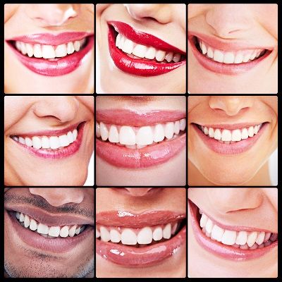 Get An Ideal Smile With Dental Veneers