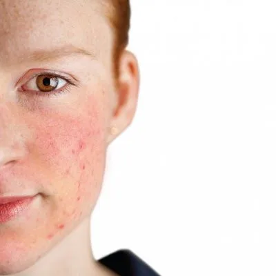 Rosacea Treatment in Dubai
