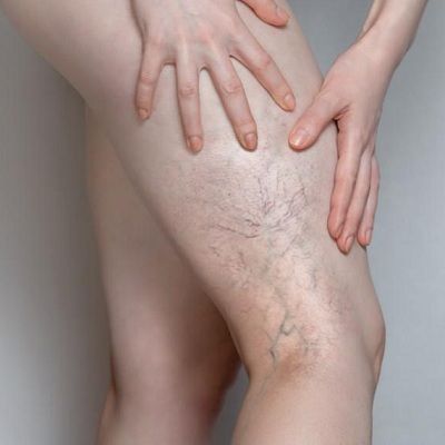 5 Ways to Stop Spider Veins From Spreading