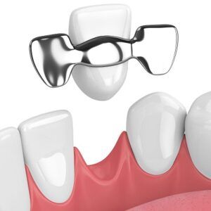 Types of Dental Bridges & Procedure Steps