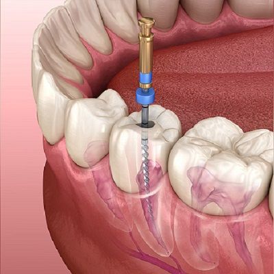 When is the Root Canal Possible When the Root is Iinfected