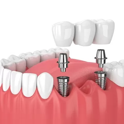 dental implants dubai