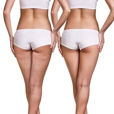 Cellulite Treatment | Causes of Cellulite on Thigh and Bum