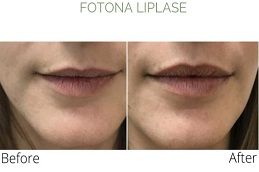 Fotona 4D Lip Augmentation