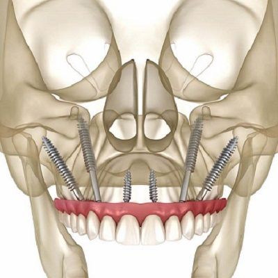How Much Do Zygomatic Implants Cost