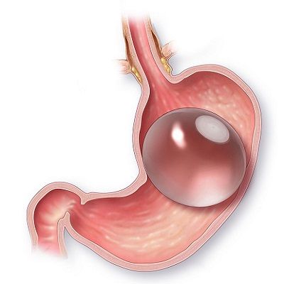 How Successful are Gastric Balloons