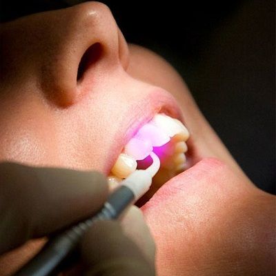 Root Canal Treatment by Laser