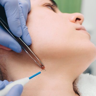 Skin Tag Removal With Laser